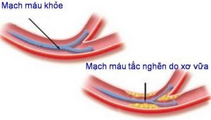 Bệnh máu nhiễm mỡ và những khôn lường khi gặp phải.