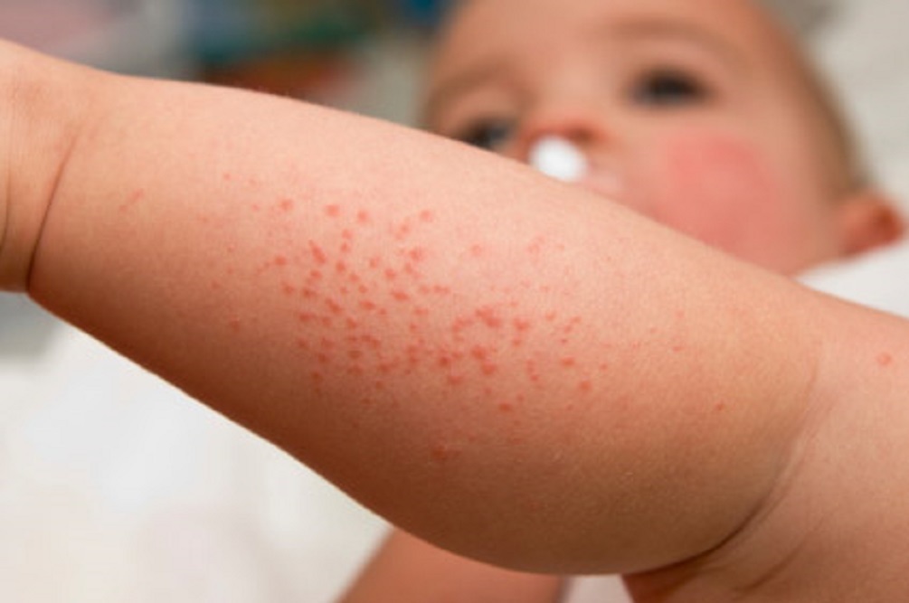 Chữa bệnh dị ứng trên da ở trẻ nhỏ hiệu quả