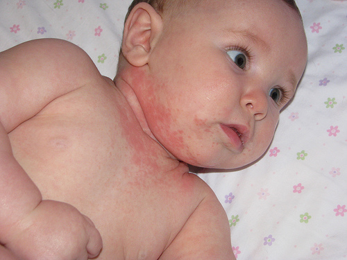 Chữa bệnh dị ứng trên da ở trẻ nhỏ hiệu quả