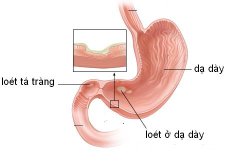 Bệnh viêm loét dạ dày tá tràng