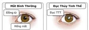 Khi có dấu hiệu đục nhân mắt bạn nên đi khám mắt ngay nhé.