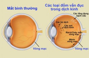 Khi thấy mắt có những dấu hiệu khác thường bạn nên bổ sung viên bổ mắt viditon - Vitafood.