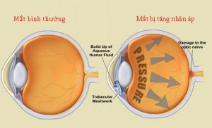 Tăng nhãn lực là một bệnh khá nguy hiểm ở mắt.