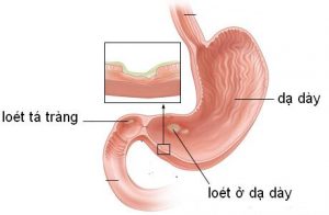 Uống chè dây có tốt không - Điều trị bệnh loét dạ dày - tá tràng